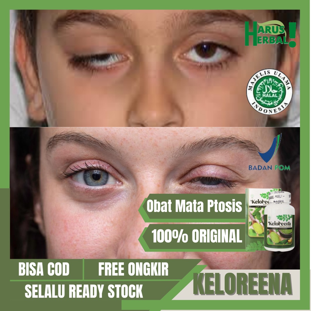 Obat Mata Ptosis, Kelopak Mata Turun Sebelah, Obat Mata Sipit Sebelah, Obat Kelopak Mata Kendur, Kel