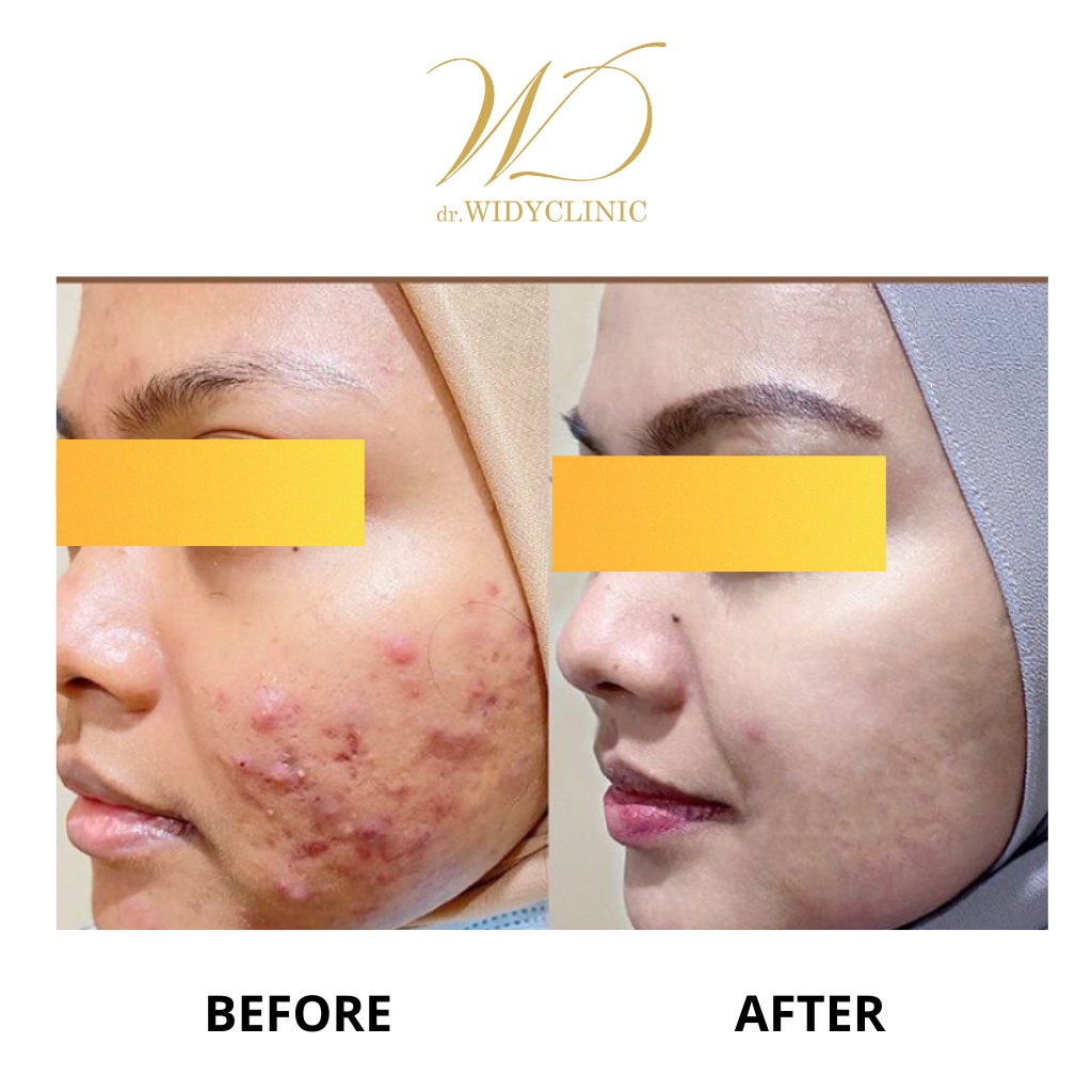 Dr Widy Clinic Acne Skincare | Paketan Jerawat &amp; Beruntusan Untuk Semua Jenis Kulit | BPOM &amp; Halal MUI Formulasi Dokter | Bekas Jerawat Mencerahkan Glowing