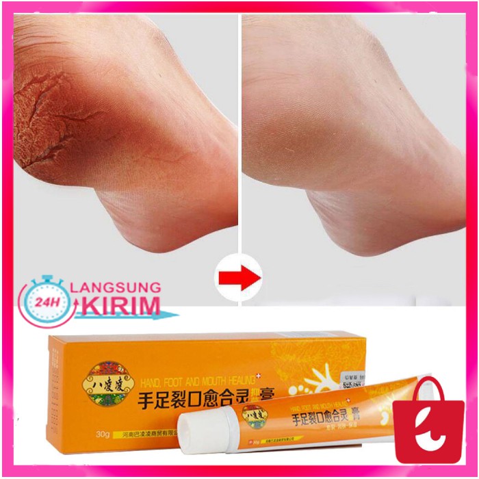 [100% Asli + COD] Obat Kaki Tangan Kapalan Pecah - Pecah Krim Tumit Pecah-pecah Mengupas Kaki