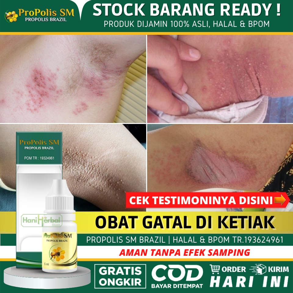 Obat Gatal di Ketiak, Obat Gatal Jamur di Ketiak, Penghilang Gatal Gatal di Ketiak, Obat Gatal Ketia