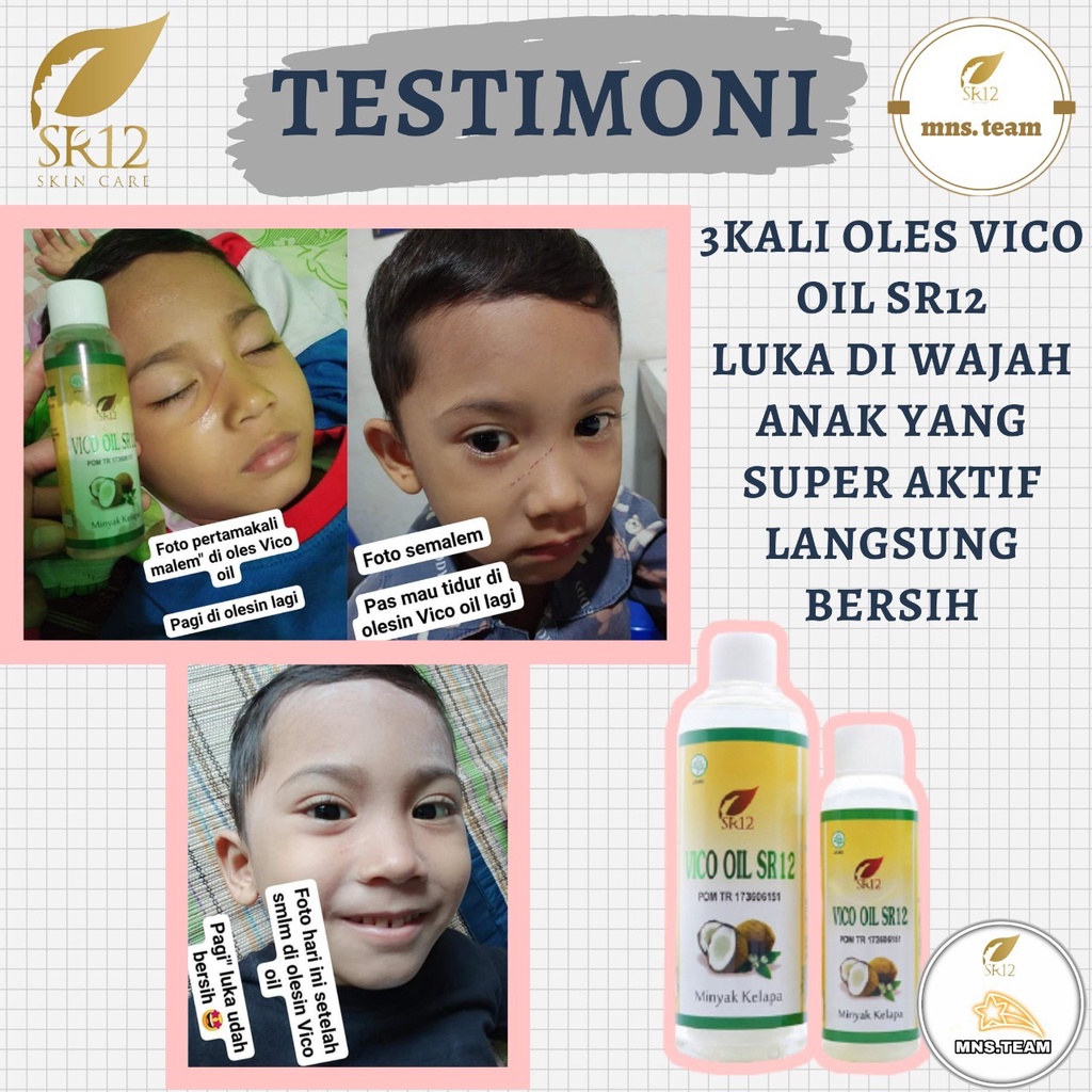 Vco Virgin Coconut Oil Untuk Ruam Popok Bayi Bruntusan Eksim Menghilangkan  Cradle Cap Treatment Baby Lemak Tambahan Mpasi