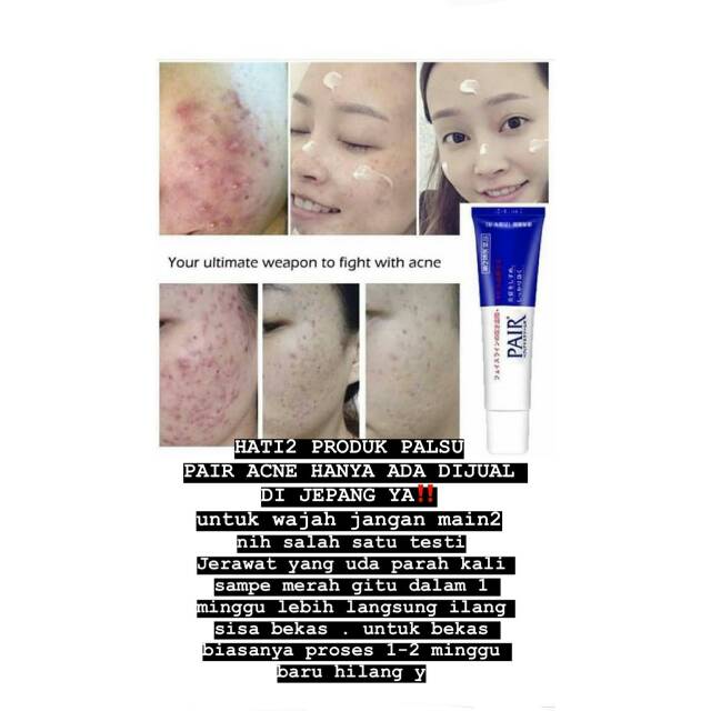 pair acne cream palsu