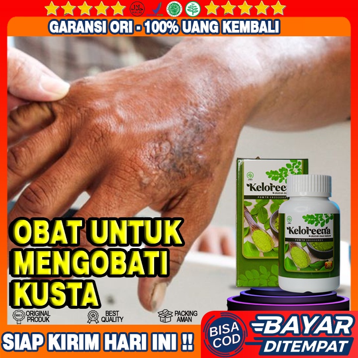 Obat Kusta, Obat Lepra, Obat Hansen, Obat Kusta Kering, Obat Kusta Basah