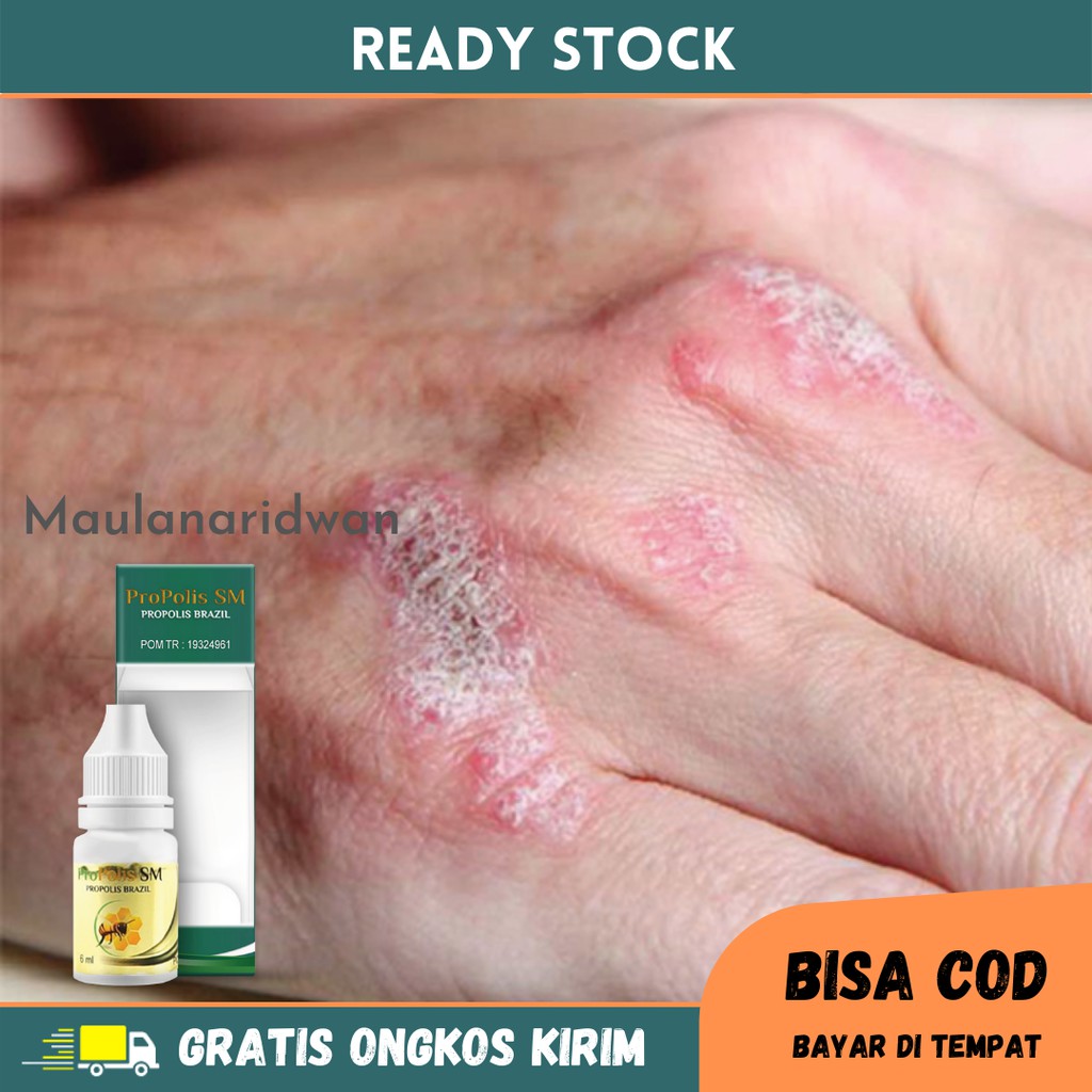 Obat Eksim Kering Menahun, Ruam Gatal Di Kulit, Kulit Kering Dan Gatal, Obat Gatal Eksim, Obat Oles 