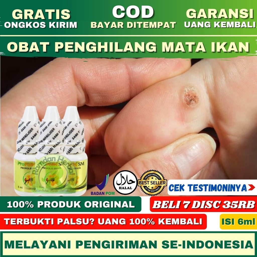 <Bertestimoni> Obat Mata Ikan / Obat Mata Ikan Kaki / Mata Ikan Di Telapak Kaki / Bukan Plester Obat