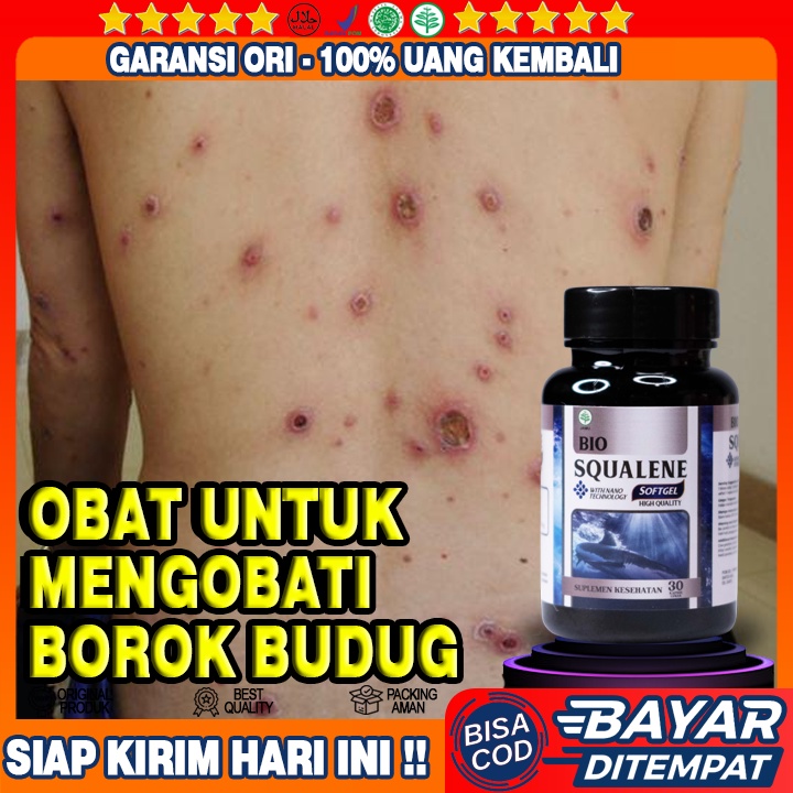Obat Borok Budug - Obat Gatal Budug - Obat Penghilang Bekas Budug - Obat Budug Bernanah - Obat Scabi