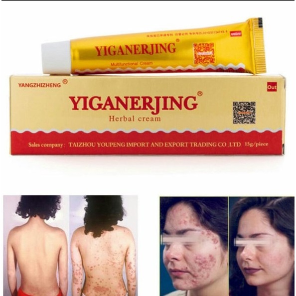 Yiganerjing Obat Salep Dermatitis Eksim /Gatal Selangkangan Anti Jamur Kudis Kurap &amp; Gigitan Serangga