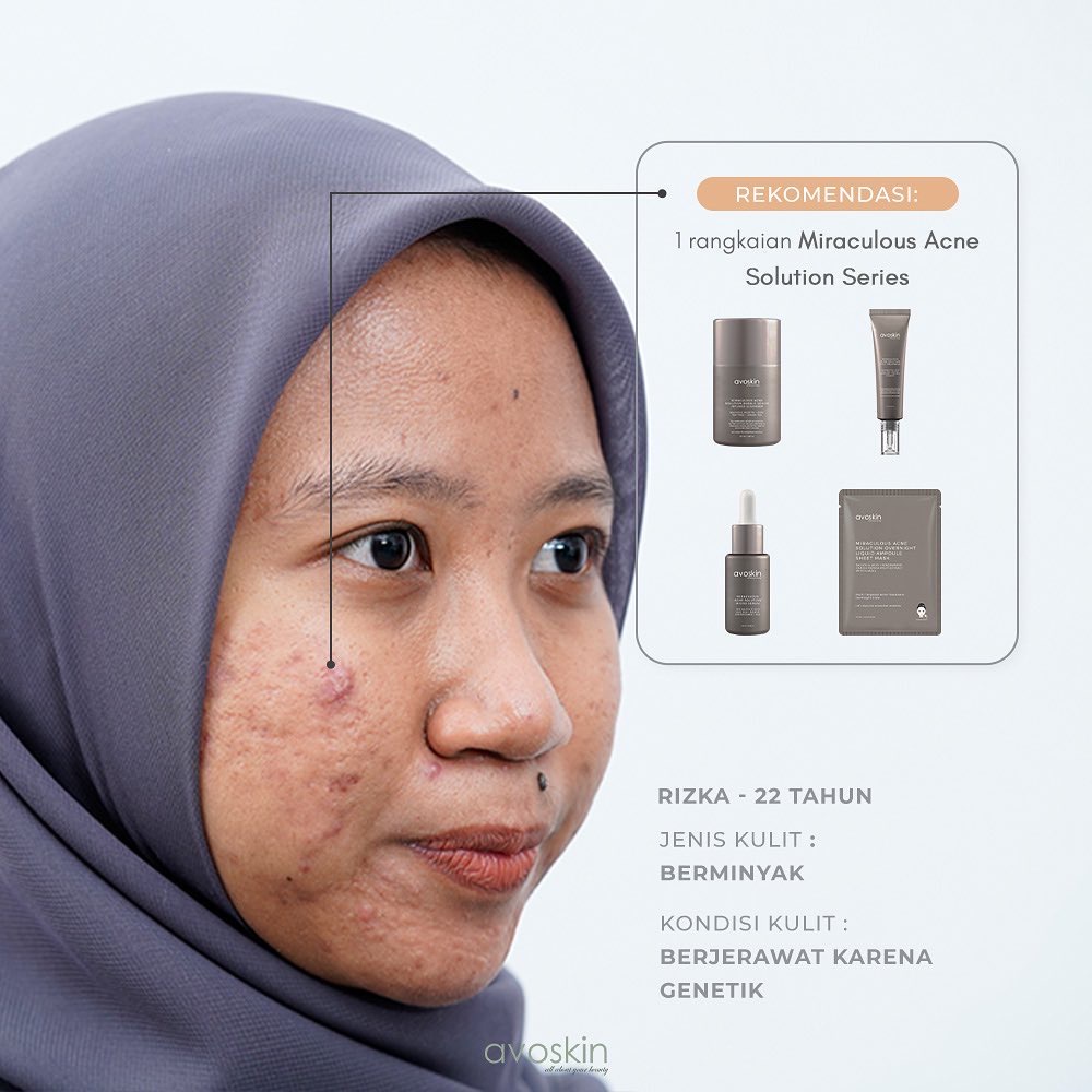 AVOSKIN Miraculous Acne Solution Indonesia / Bubble-Serum Infused Cleanser Micro Serum Spot Treatment Overnight Liquid Ampoule Sheet Mask / Cleanser Toner Essence Mist Day Night Eye Cream Sunscreen Masker / You Skin Bae YSB Skin Care Face Paket Set Wajah