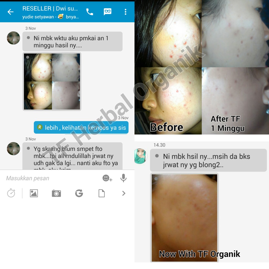 Obat Jerawat Alami Organik