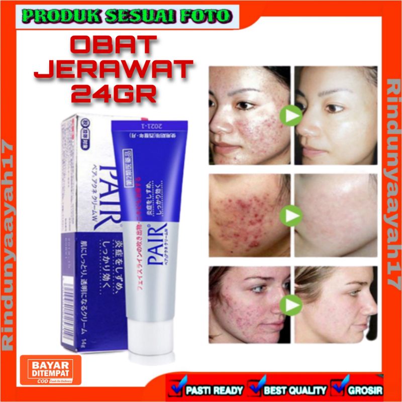 [RA] LION PAIR JAPAN 24GR ACNE CREAM OBAT JERAWAT CARE WAJAH ANTI BACTERIA BAKTERI