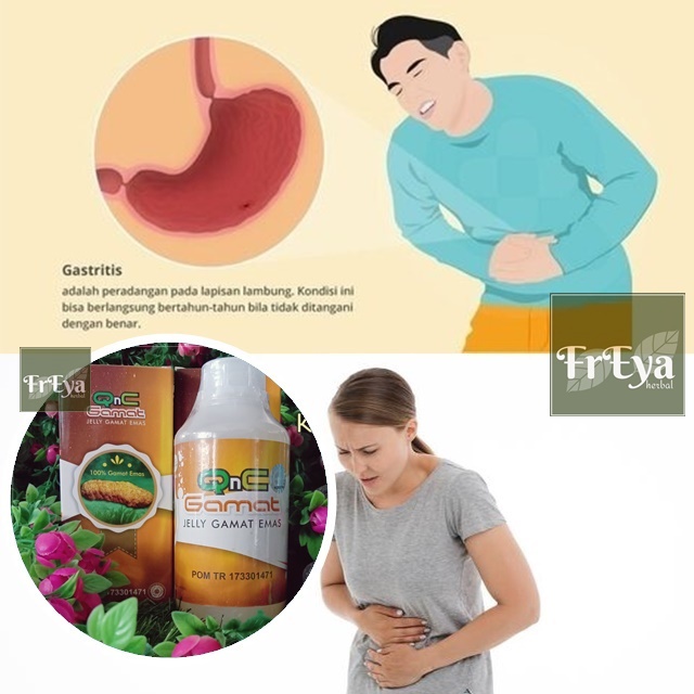 OBAT MAAG KRONIS, OBAT HERBAL GASTRITIS KRONIS, OBAT GASTRITIS, OBAT MAAG AKUT, OBAT SAKIT LAMBUNG (