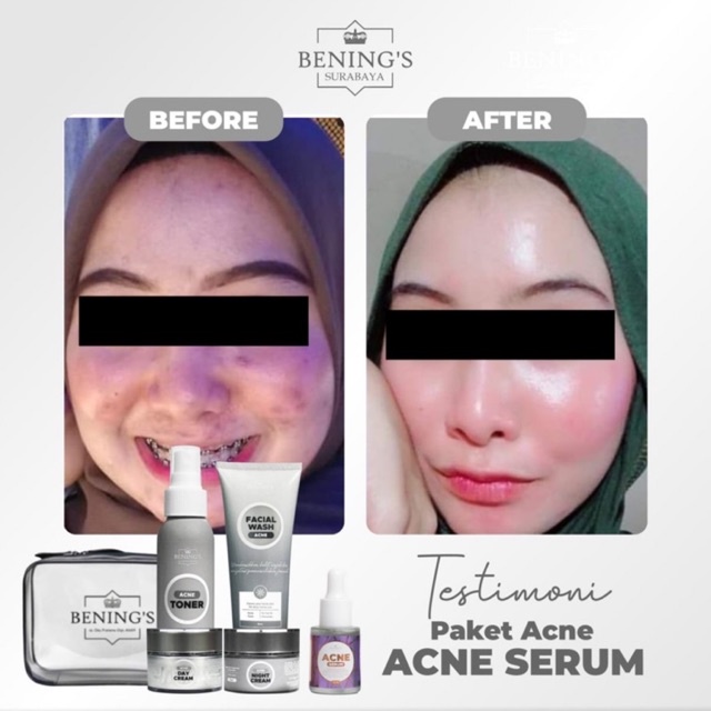 BENING'S PAKET ACNE | MENGATASI JERAWAT, BRUNTUSAN &amp; MENCERAHKAN KULIT