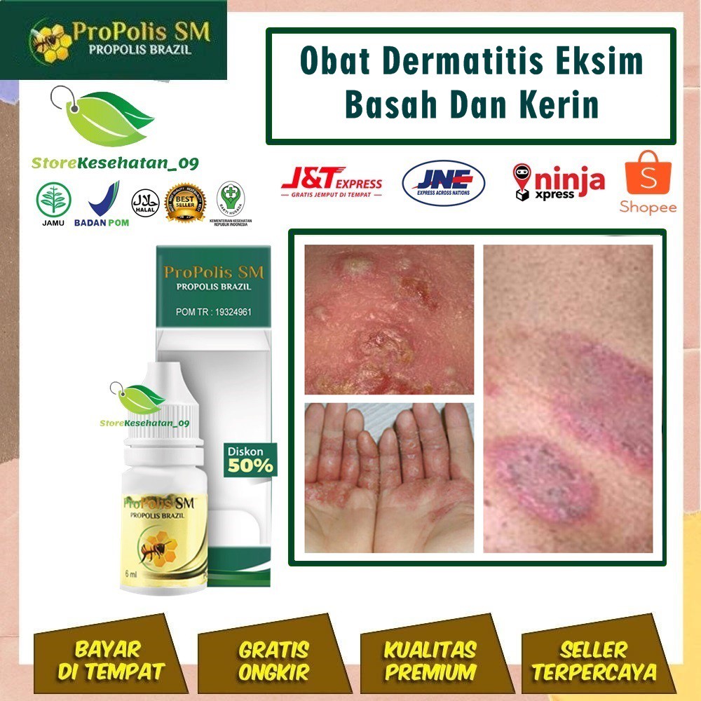 Obat Dermatitis Eksim Basah Dan Kering Obat Kulit Bersisik Di Kepala Leher Siku Tangan Kaki Lutut Shopee Indonesia