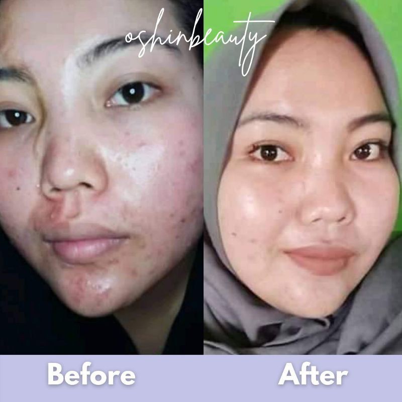 Oshin Beauty | Oshinbeauty | Paket Acne Series | Paket Glow Series | Ecer/Satuan BPOM