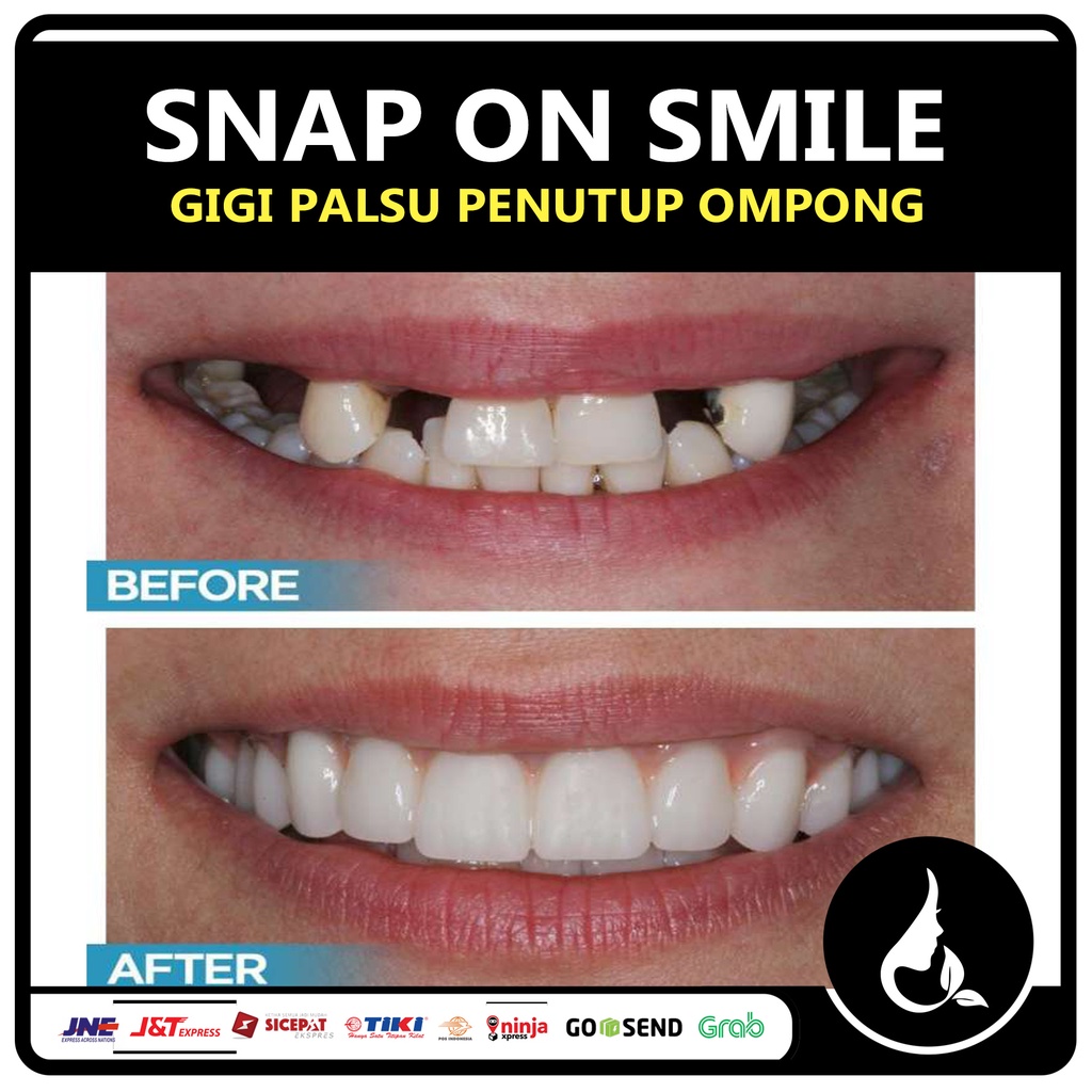 Snap On Smile Veneers Original Snap Smile Veneer Snap On Smile Original Veneer Gigi Palsu Atas Bawah