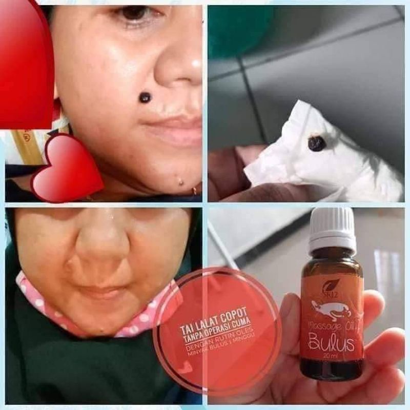 Minyak Bulus SR12/ Minyak Virall / Menghilangkan Kutil & Tahi lalat