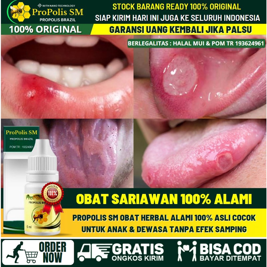 Obat Sariawan di Lidah 100% Alami, Luka Lecet di Lidah, Obat Cair Sariawan di Lidah, Obat Sariawan d