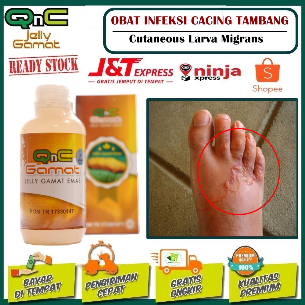 Obat Infeksi Cacing Tambang Qnc Jelly Gamat 100 Obat Herbal Asli Halal Bpom Ri Original Shopee Indonesia