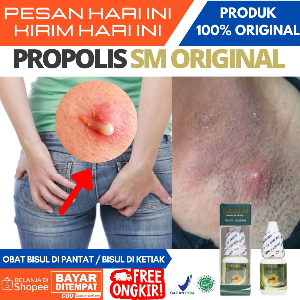 Obat Herbal Bisul di Bokong / Bisul di Pantat, Ketiak, di kepala / Bisul di Payu Dara / Obat Tetes T