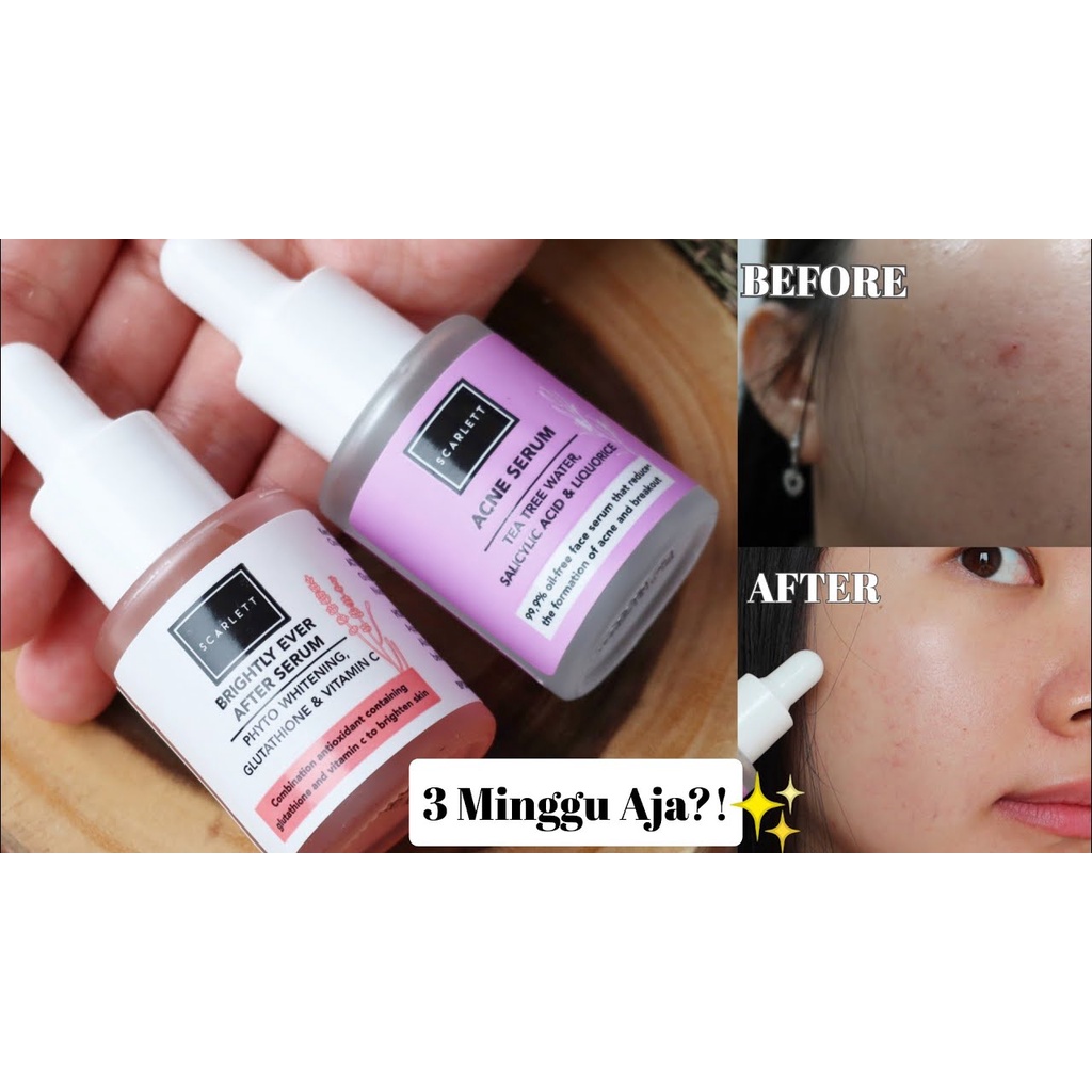 [ORI] Serum Mini Scarlett Acne Meredakan Jerawat Meradang Iritasi Kemerahan Meregenerasi Kulit I BPOM 15ml