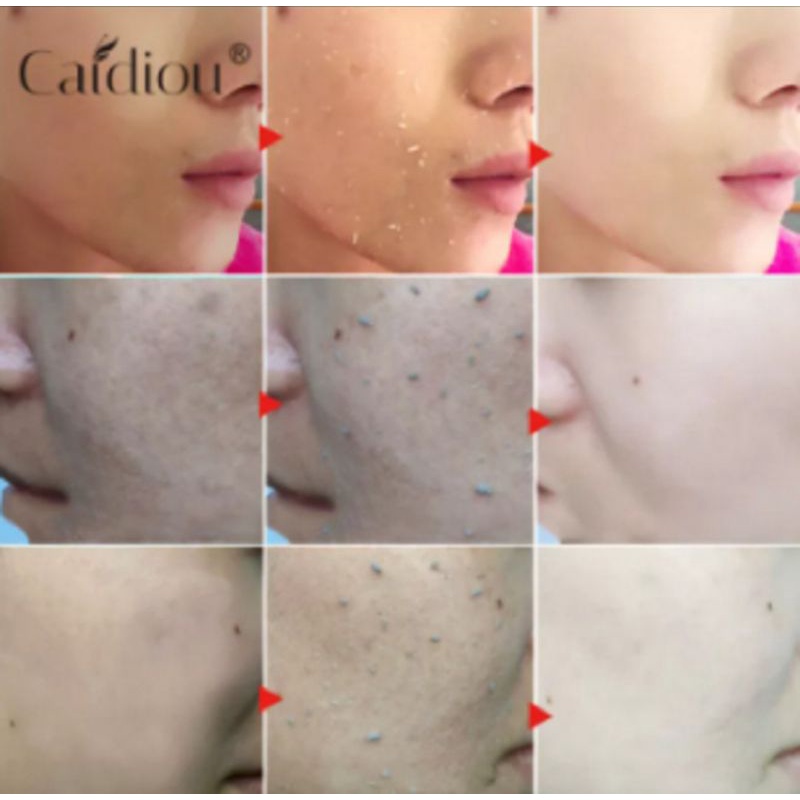 PENGHILANG KULIT MATI REMOVE DEAD SKIN CARE EXFOLIATING CAIDIOU
