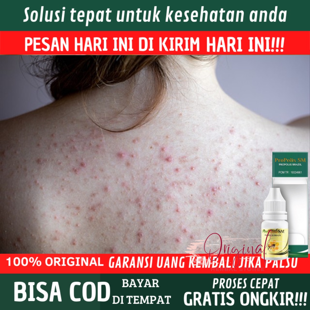 Obat jerawat punggung dan bokong, Obat Jerawat bokong, Sabun Jerawat Punggung, Penghilang jerawat bo