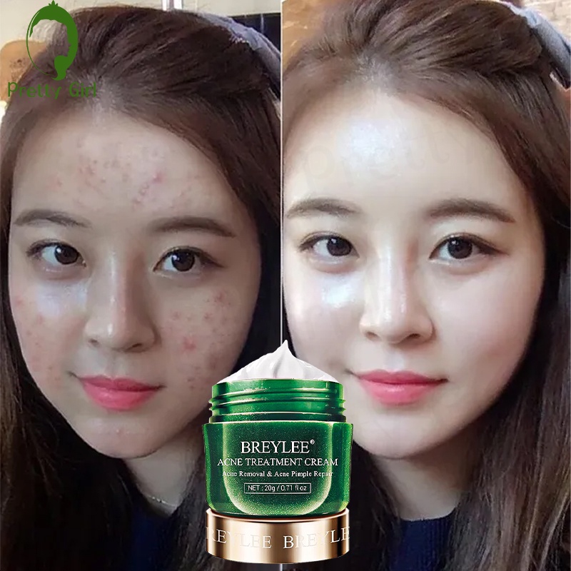 【asli】BREYLEE Acne Treatment Cream - Krim Jerawat &amp; Komedo Wajah , Memperbaiki Kulit &amp; Mengecilkan Pori Wajah (20 g)