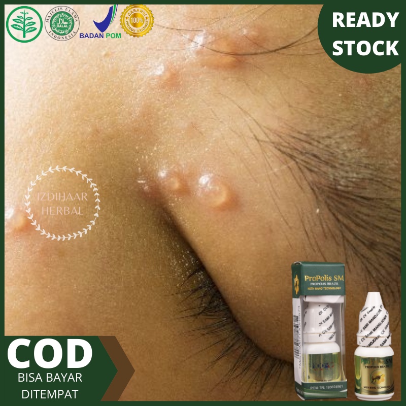 Obat Gatal Berair di Jari Tangan dan Kaki, Obat gatal berair di jari dan tangan, Obat Bintik Bening,