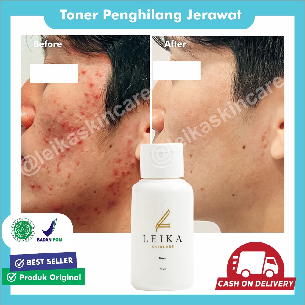 AMPUH Toner Jerawat Perawatan Wajah Jerawat Bruntusan Toner Wajah Penghilang Jerawat dan Bekas Jeraw