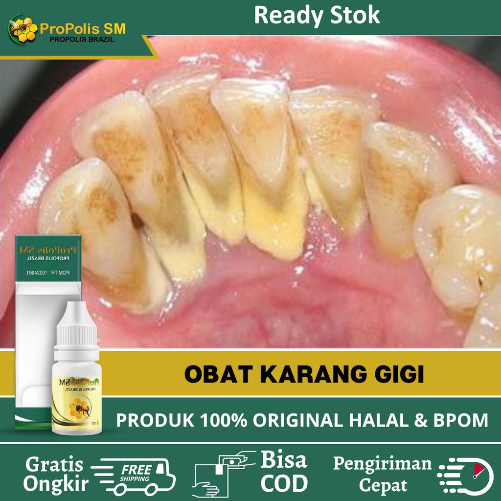 Obat Karang Gigi, Obat Membersihkan Karang Gigi, Obat Karang Gigi Parah, Obat Penghilang Karang Gigi