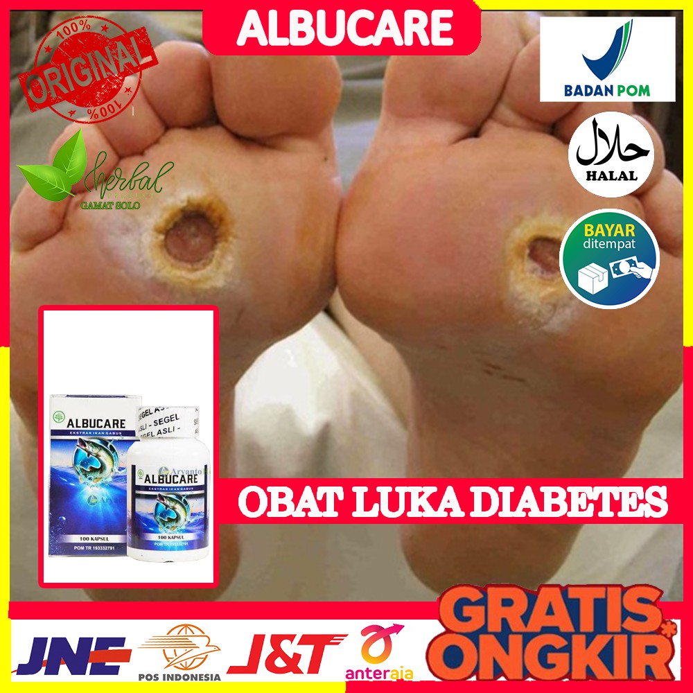 Obat Diabetes Basah, Diabetes Kering, Diabetes Melitus, Penyembuh Luka Diabetes, Albucare di Solo