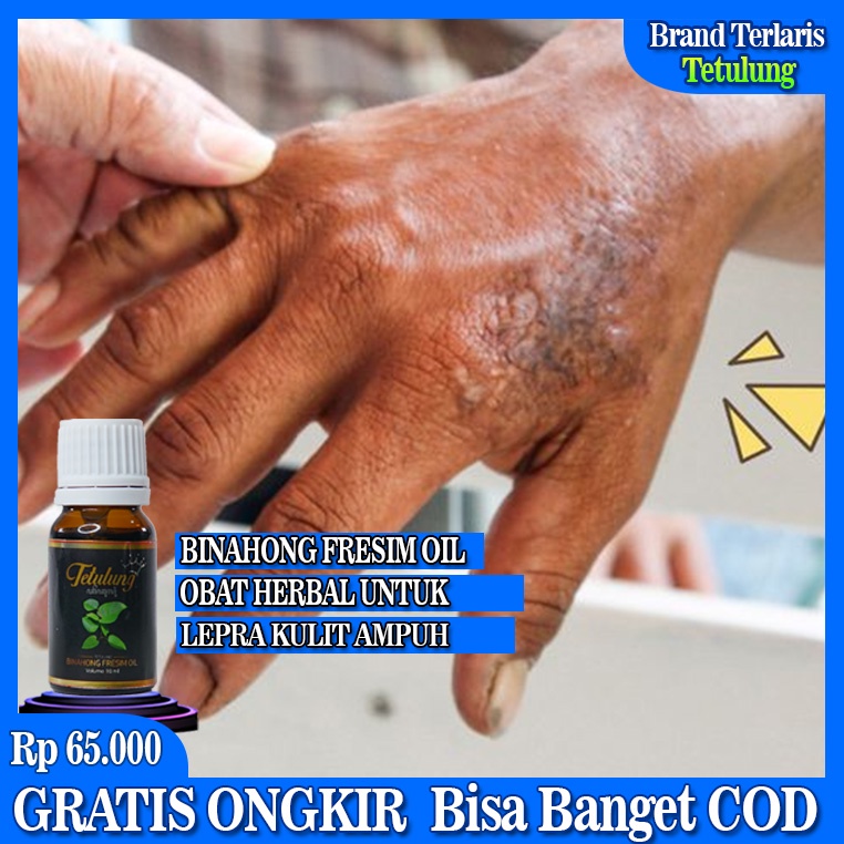 Fresim Oil, Obat Lepra, Lepra Kulit, Obat Lepra Ampuh, Kusta Kering, Obat Herbal Alami Untuk Lepra K
