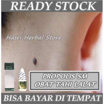 Obat Tetes Tahi Lalat - Obat Tahi Lalat Di Wajah, Leher - Penghilang Tahi Lalat I Propolis SM Brazil