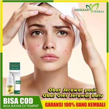 Obat Jerawat pasir/Obat Oles Jerawat batu | Herbal Penghilang Jerawat di Wajah, di dagu, Di Pipi, Pu