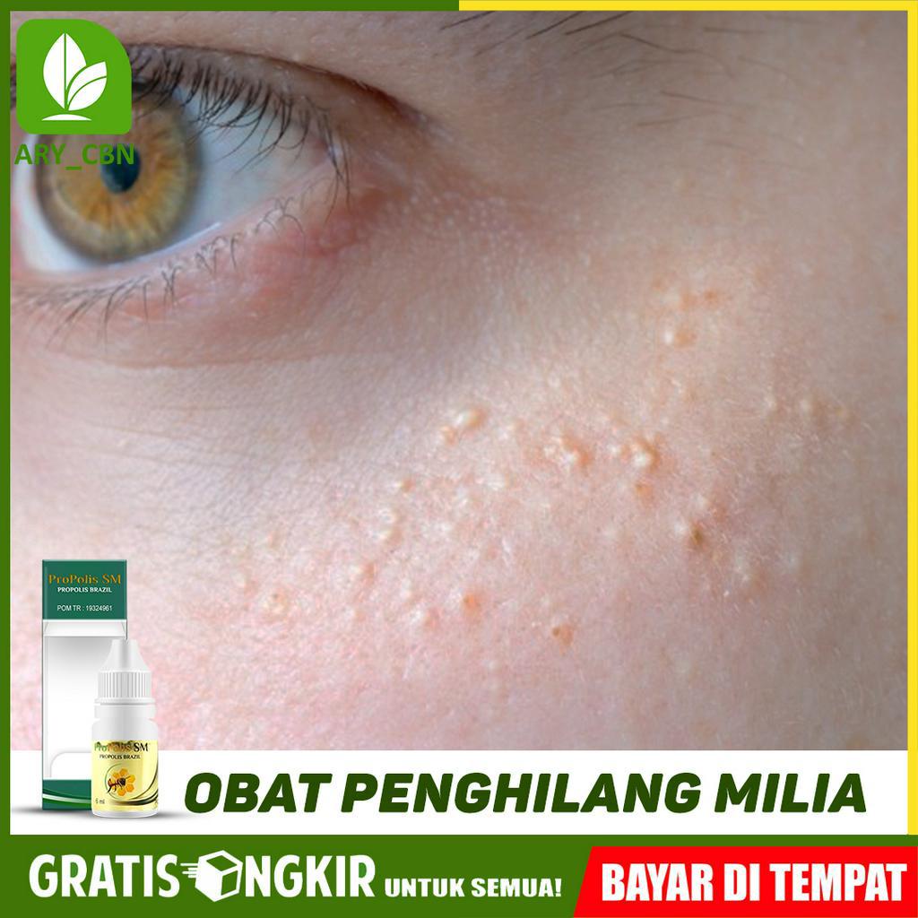 Obat Penghilang Milia Menghilangkan Milia dan Bintik dan Beruntusan Di Wajah Propolis SM Cirebon