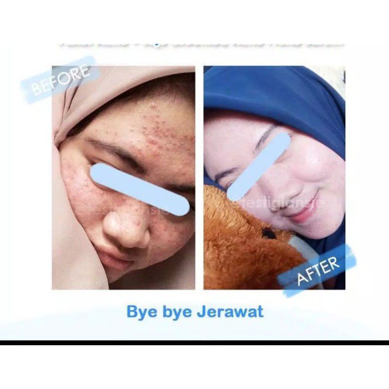 Sabun Glowing Penghilang Jerawat Bruntusan Noda Hitam Wajah Glowing Bebas Flek Hitam Sabun CDA 1000% Ori