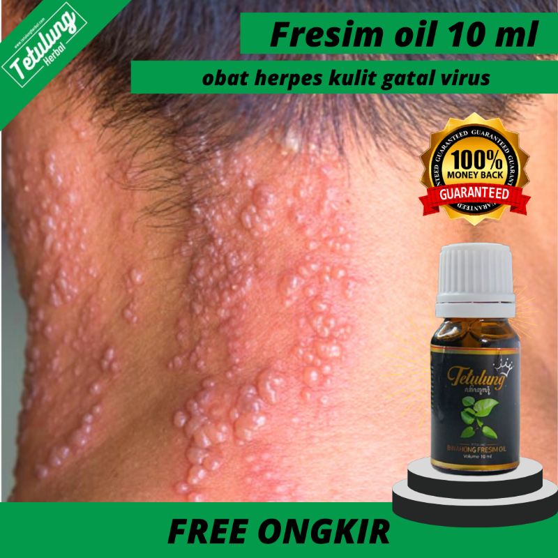 Obat Herpes Kelamin Paling Ampuh , Obat Herpes Kulit Herbal , Obat Herpes Kulit Kemaluan Pria Wanita