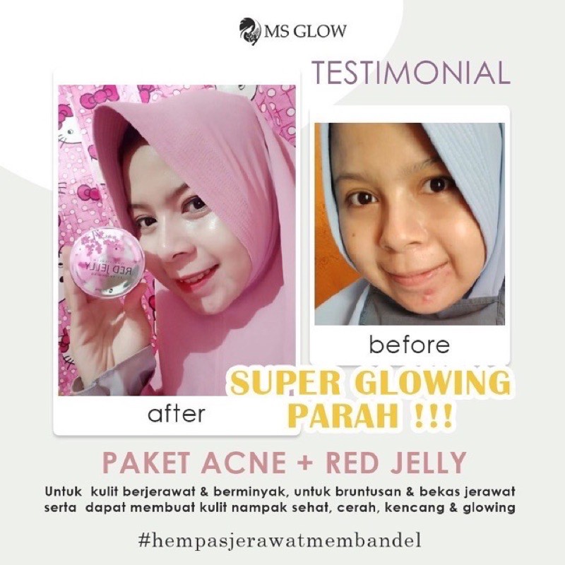 [PAKET HEMAT] MS GLOW Ultimate Series Indonesia / Acne Whitening Luminous Facial Toner Serum Cream