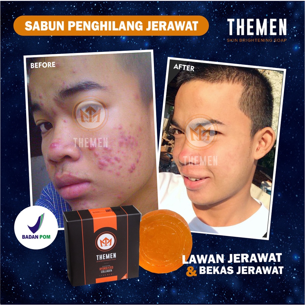 Bagus Men Sabun Penghilang Jerawat Untuk Laki Laki Obat Jerawat Paling Ampuh Pria Sabun Cuci Muka Pe