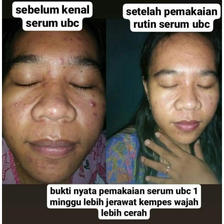 SERUM ACNE SERUM JERAWAT UBC ACNE SPOT SERUM BPOM