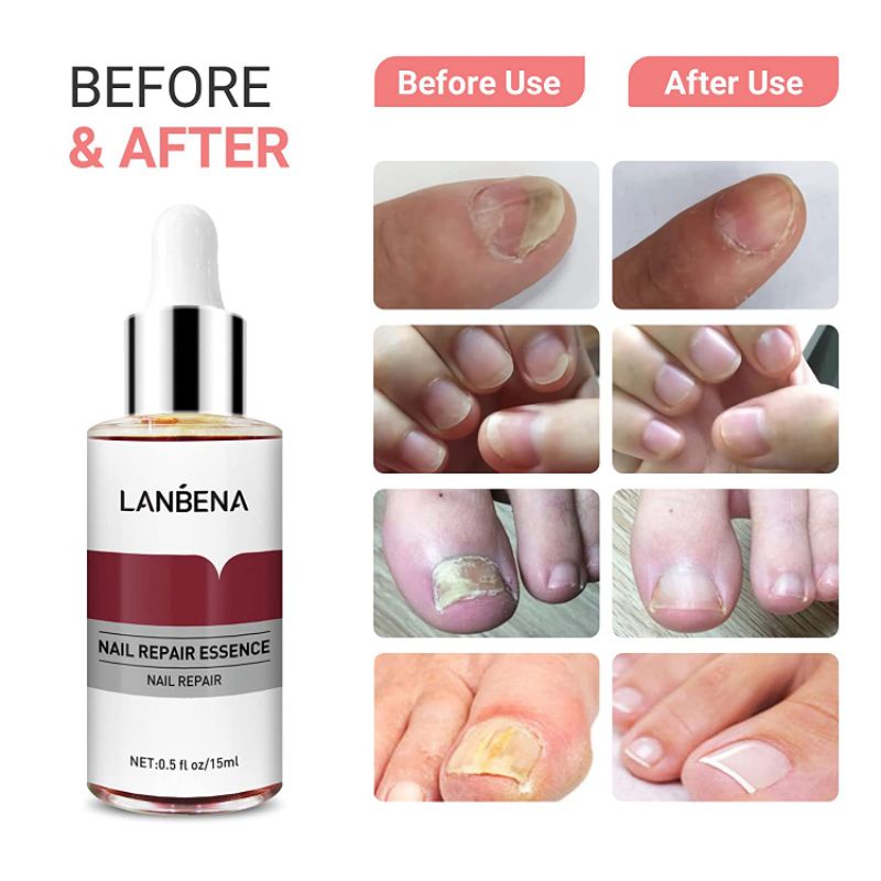 Lanbena Nail Repair Essence [Gratis Alat Kikir Kuku] / Lanbena Perawatan Kuku Kaki &amp; Tangan / Lanbena Serum Perawatan Kuku / Lanbena Oil Serum Nail Treatment / Lanbena Perawatan Kuku Esensi Serum Jamur Kuku / Serum Perawatan Jamur Kuku Pecah Kasar