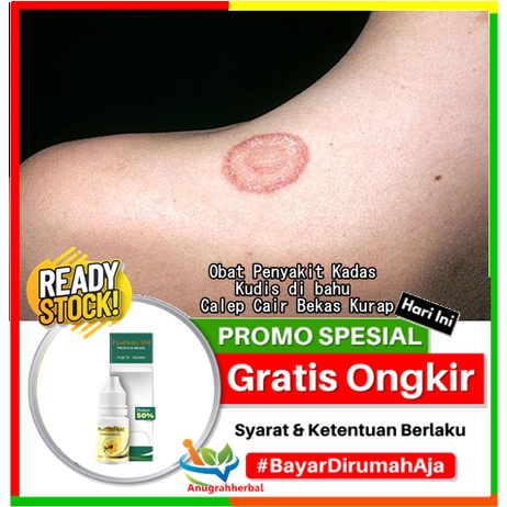 Obat Penyakit Kadas - Kudis di bahu, Salep Cair Bekas Kurap, Penghilang Bekas Kurap Menghitam - Meng