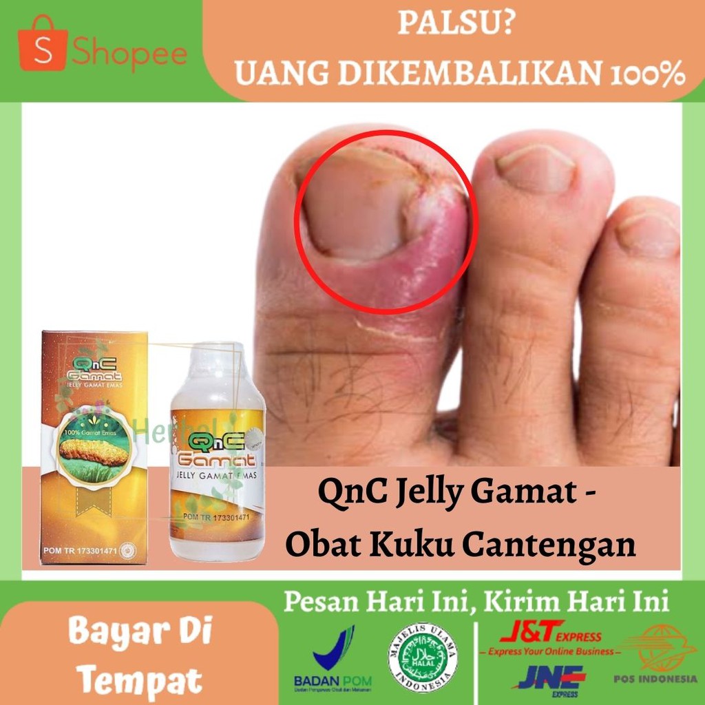 obat cantengan jempol kaki
