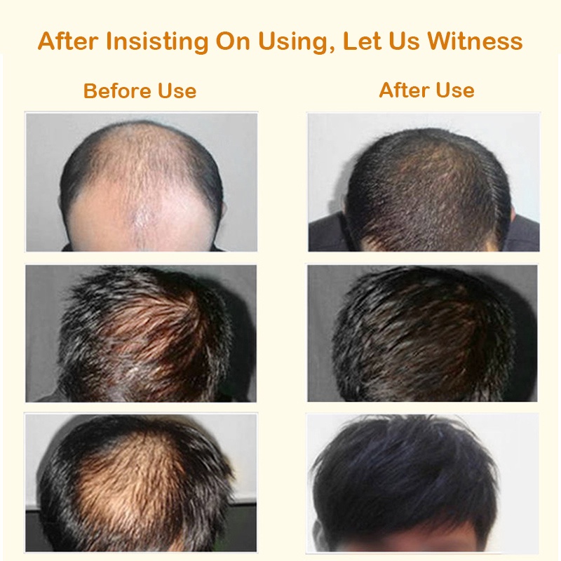 Shampo Penumbuh Rambut Cepat Serum Rambut Rontok Botak Rontok Penumbuh Rambut Perawatan Hair Care Treatment Anti Rambut Rontok-2