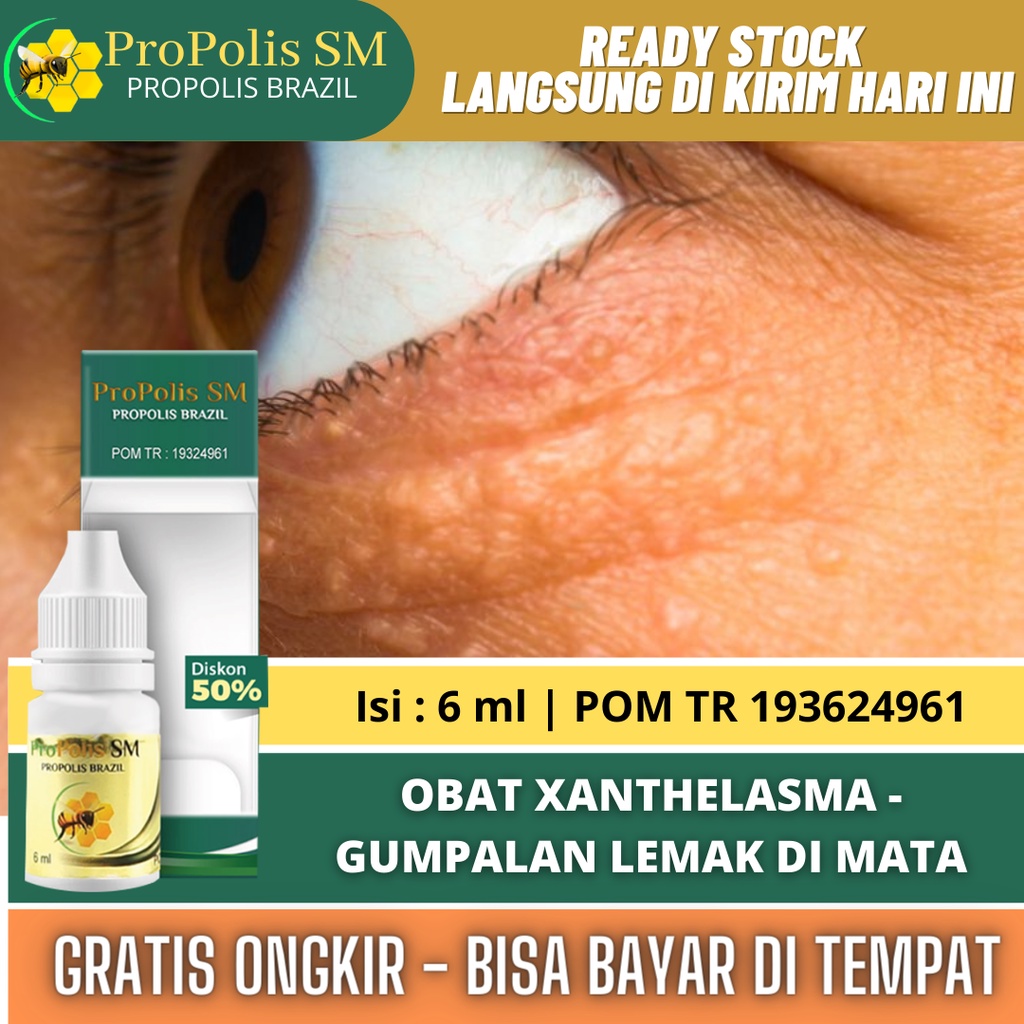 Obat Xanthelasma, Obat Penghilang Xanthelasma, Obat Gumpalan Lemak di Kelopak Mata, Obat Plak Kuning