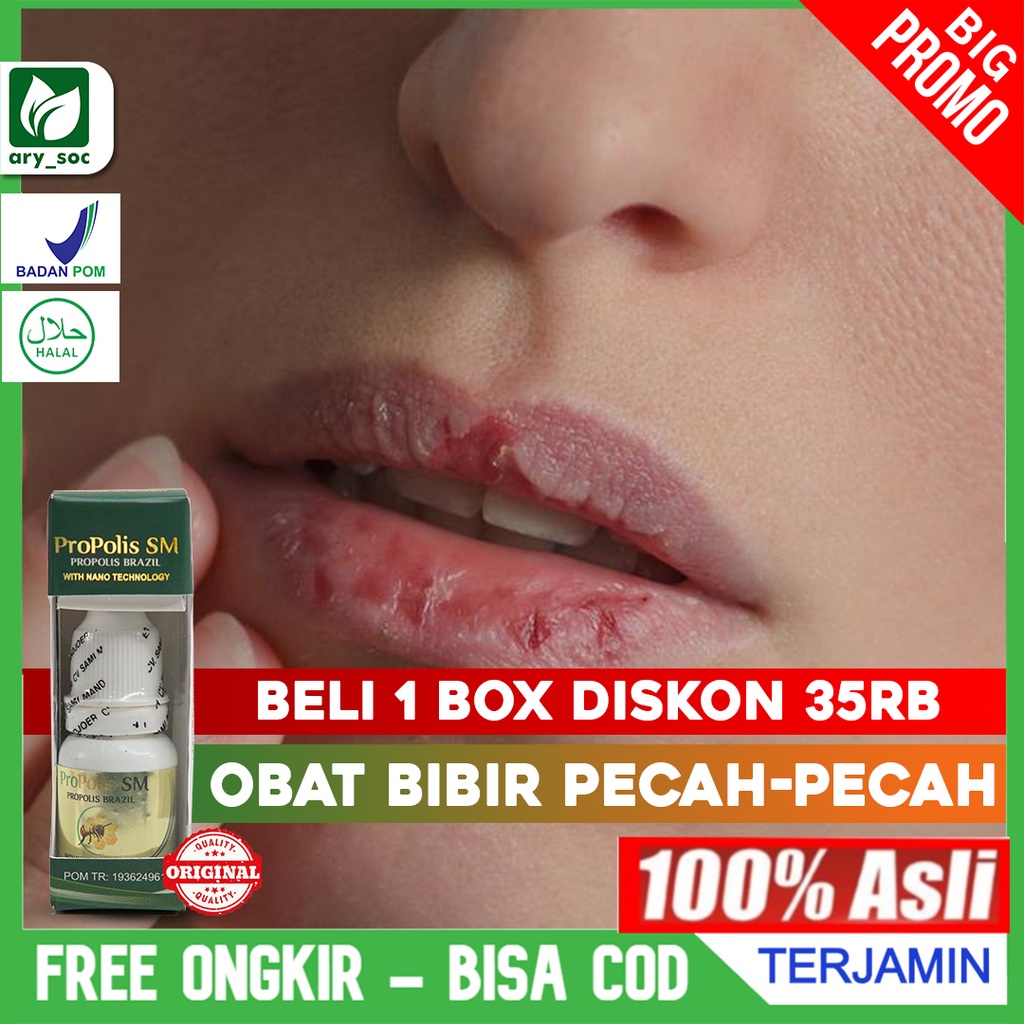 Jual Obat Bibir Pecah Pecah Sariawan Panas Dalam Bau Mulut Bibir Luka Herbal Propolis Sm