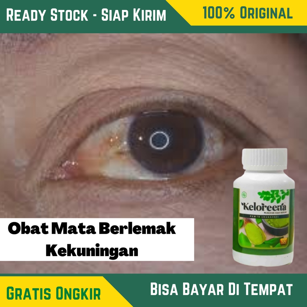 Obat Mata Berlemak Kekuningan , Obat Mata Merah Berlemak , Obat Selaput Putih Di Mata | KELOREENA