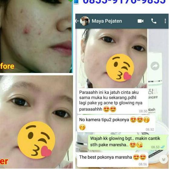 Murah YN6 ULTIMATE ACNE MARESHA 355 SKINCARE JAKSEL1 (bisa transfer / COD) 