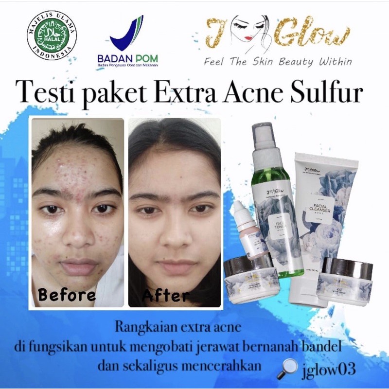 jglow Sabun jerawat / jglow skincare / jglow / facial cleanser acne