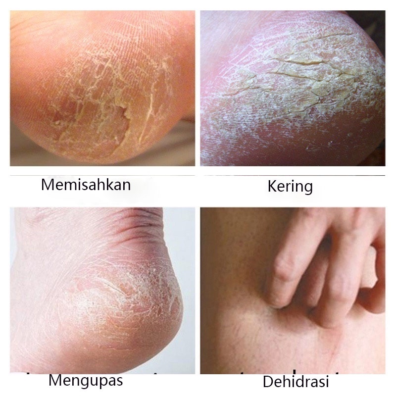 Krim Tangan dan Kaki obat kaki pecah dan kering pemutih tangan dan kaki 30g Pelembab tahan lama Memperbaiki kulit kering Memperbaiki tumit pecah-pecah